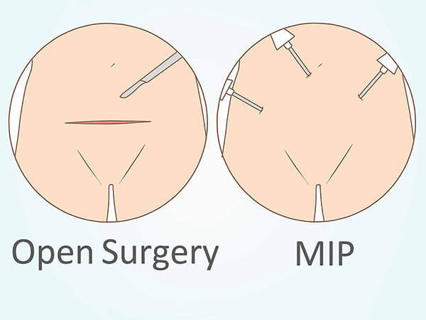 hysterectomy-8
