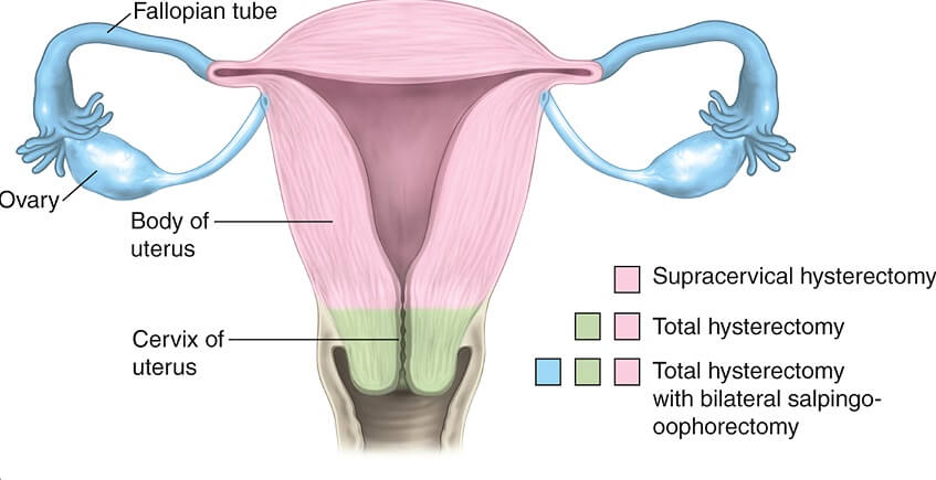hysterectomy2