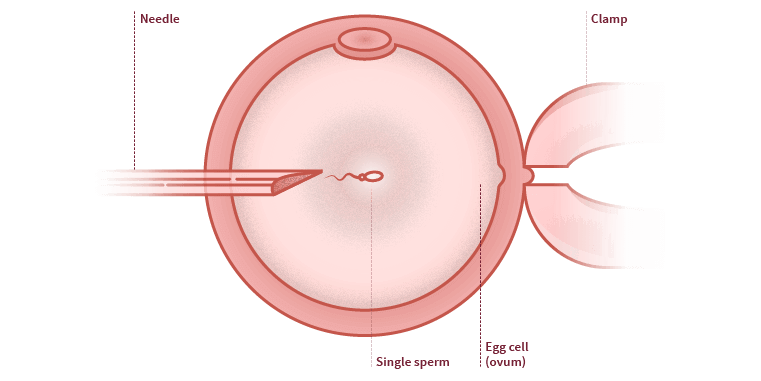 icsi-intracytoplasmic-sperm-injection-4