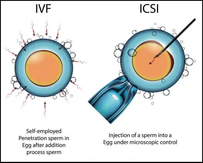 icsi-and-ivf