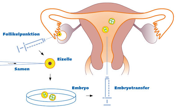 intra-cytoplasmic-sperm-injection-icsi