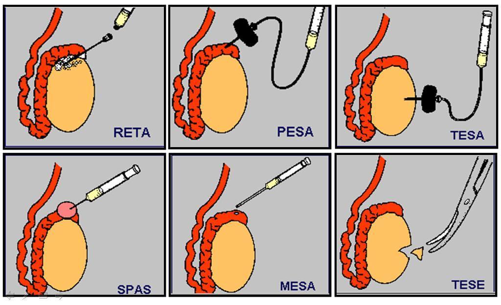 5-tesa_