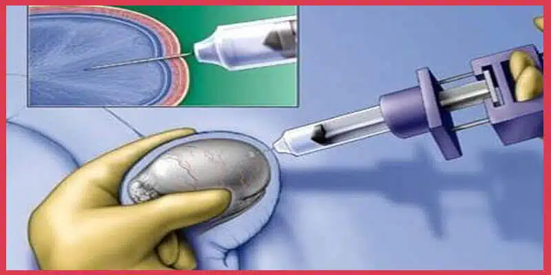 عملية استخلاص الحيوانات المنوية من الخصية