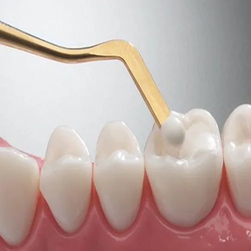 composite-filling33