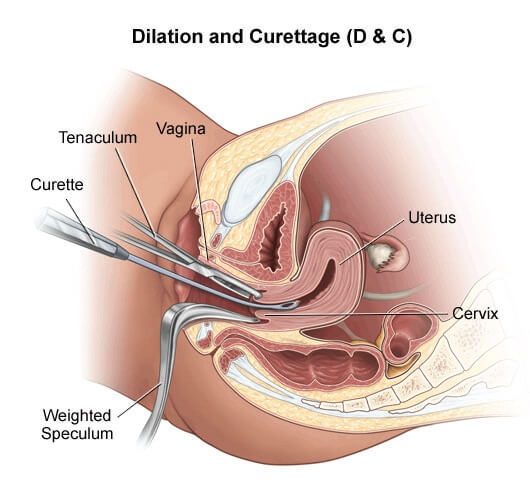 dilation-and-curetage-final
