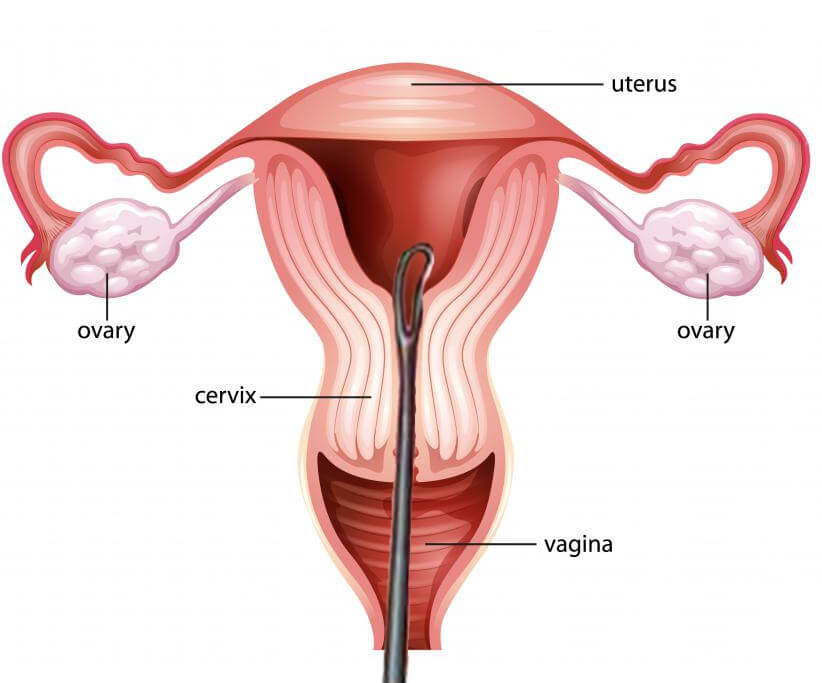 dilation-and-curettage