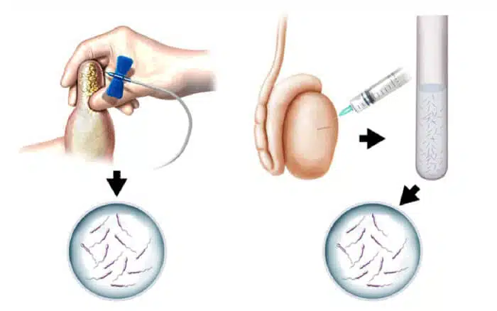التعافي ما بعد إجراء جراحة استخلاص الحيوانات المنوية من الخصية مجهرياً MicroTESE