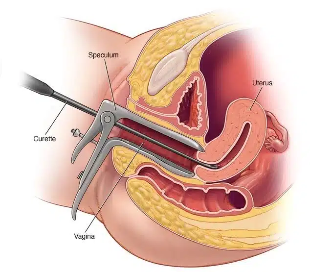 توسيع وكحت الرحم في إيران