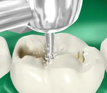 dental-fillings-pasadena