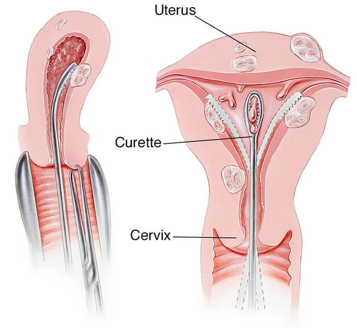dilatation-and-curettage-illustration-5a2971