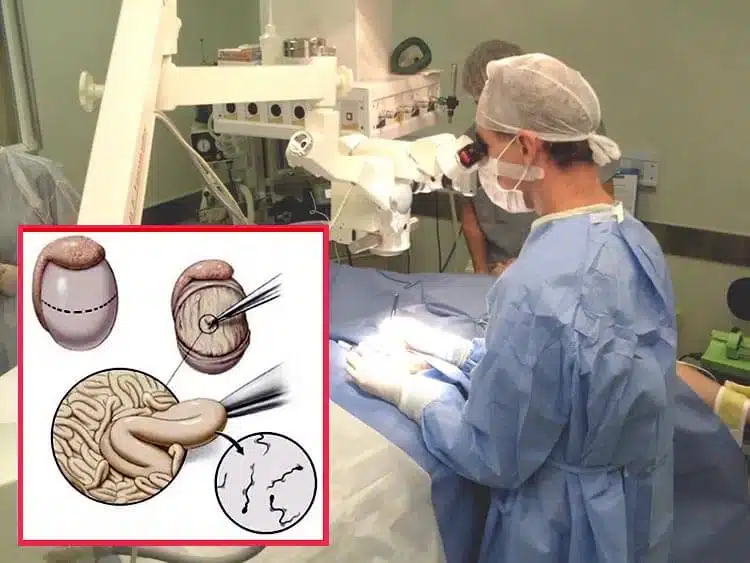 عملية استخلاص الحيوانات المنوية من الخصية