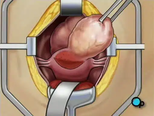 هل يمكن أن يختفي الورم الليفي في الرحم من تلقاء نفسه؟ الورم الليفي