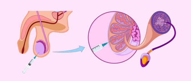 testicular-sperm-aspiration-tesa-22