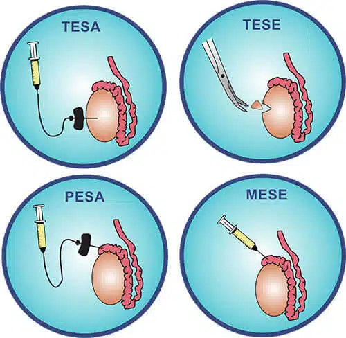 ما هي العوامل المساعده على نجاح استخلاص الحيوانات المنوية من الخصية مجهرياً