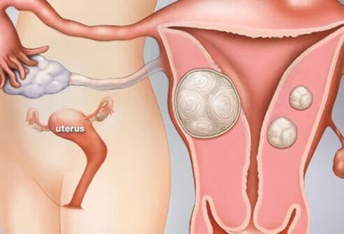 visual-guide-to-uterine-fibroids-s1-what-are-uterine-fibroids
