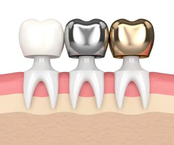 dental-crowns
