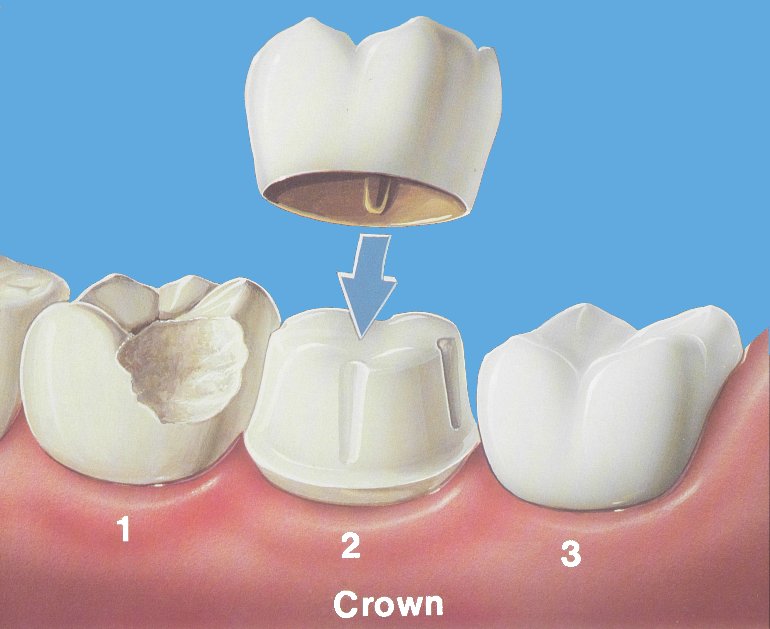 dental-crowns21414