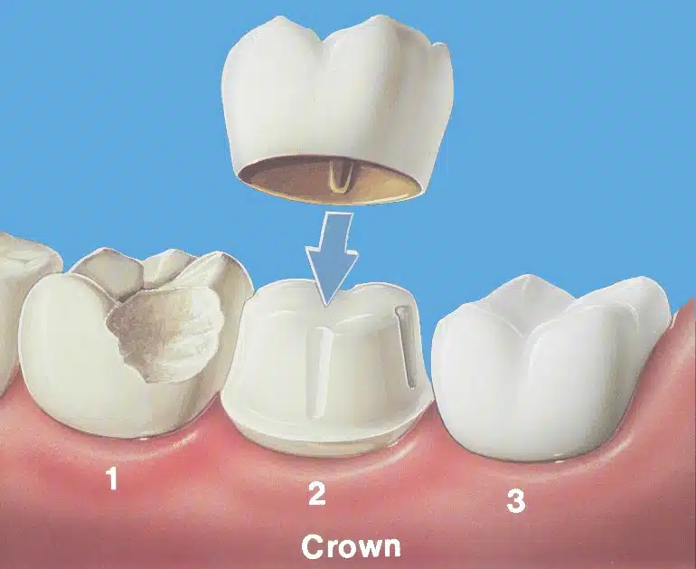 dental-crowns21414