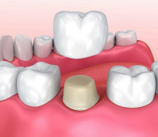 dental-crowns-e1598172061561