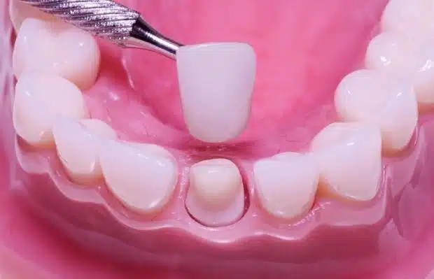 Types of dental crowns