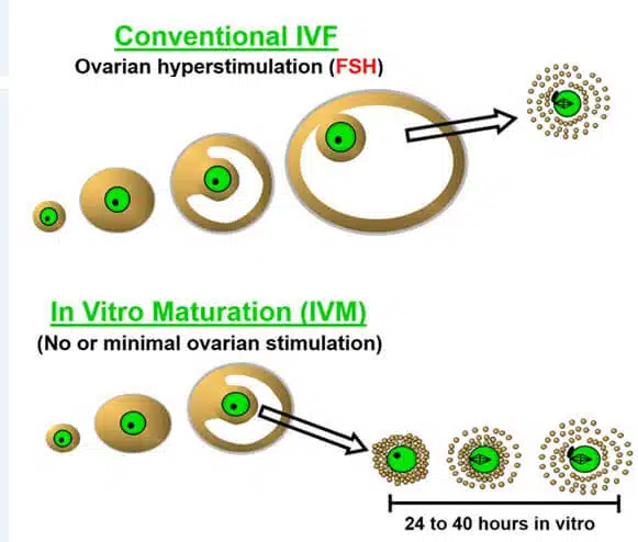 إنضاج البويضات في المختبر إنضاج البويضات في المختبر IVM
