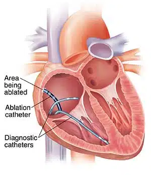 cross-section-of-heart-showing-catheters-inserted-into-right-atrium-one-ca-2