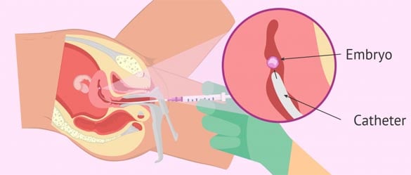 embryo-transfer