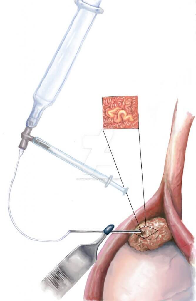 microsurgical_epididymal_sperm_aspiration__mesa__by_princesspi52-d95mrtb-667x1024
