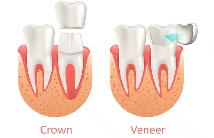 veneers-vs-dental-crowns