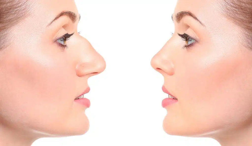 rhinoplasty-dr-panossian-los-angeles-1