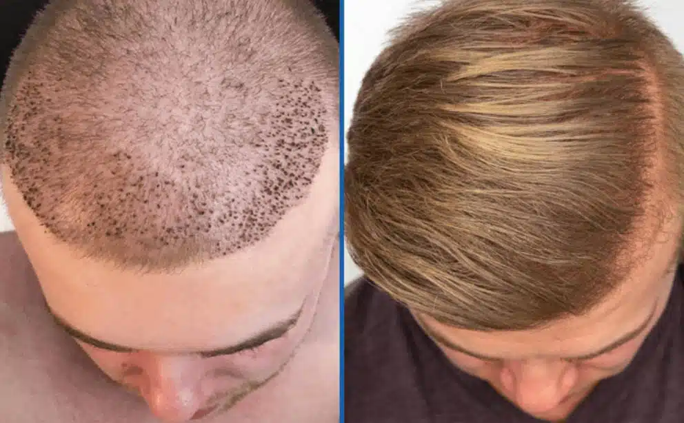 Hair transplant Photo22