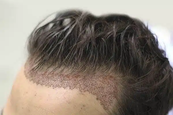natural-hair-transplant