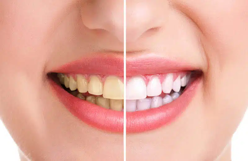 What Causes Yellow Teeth and How Can I Prevent It