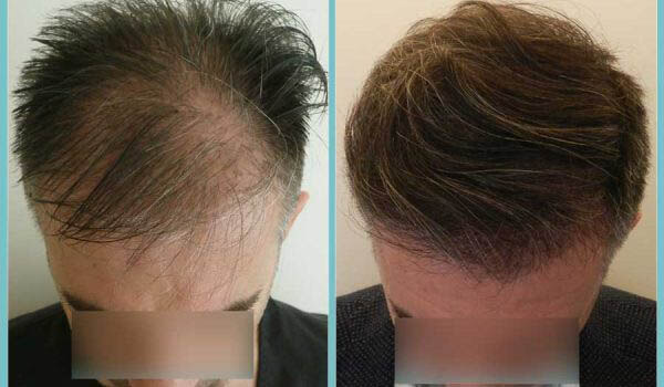 fue-hair-clinic-2-2