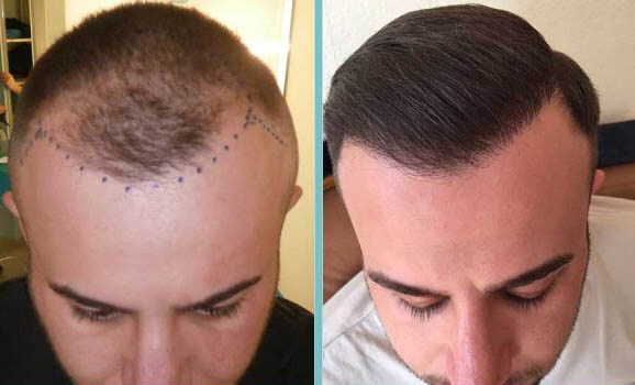 fue-hair-clinic-2
