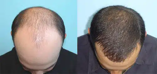hair-transplant-2