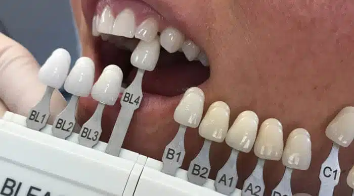 whitening-teeth-shades-1