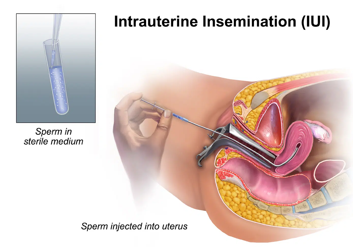 iui03