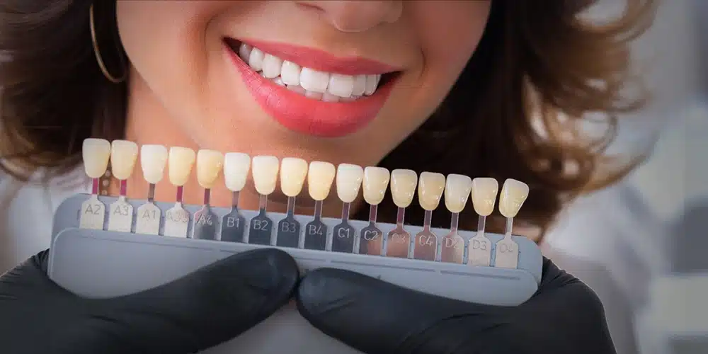 ابتسامة هوليود