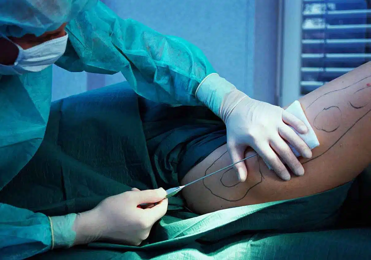 الآثار الجانبية لشفط الدهون