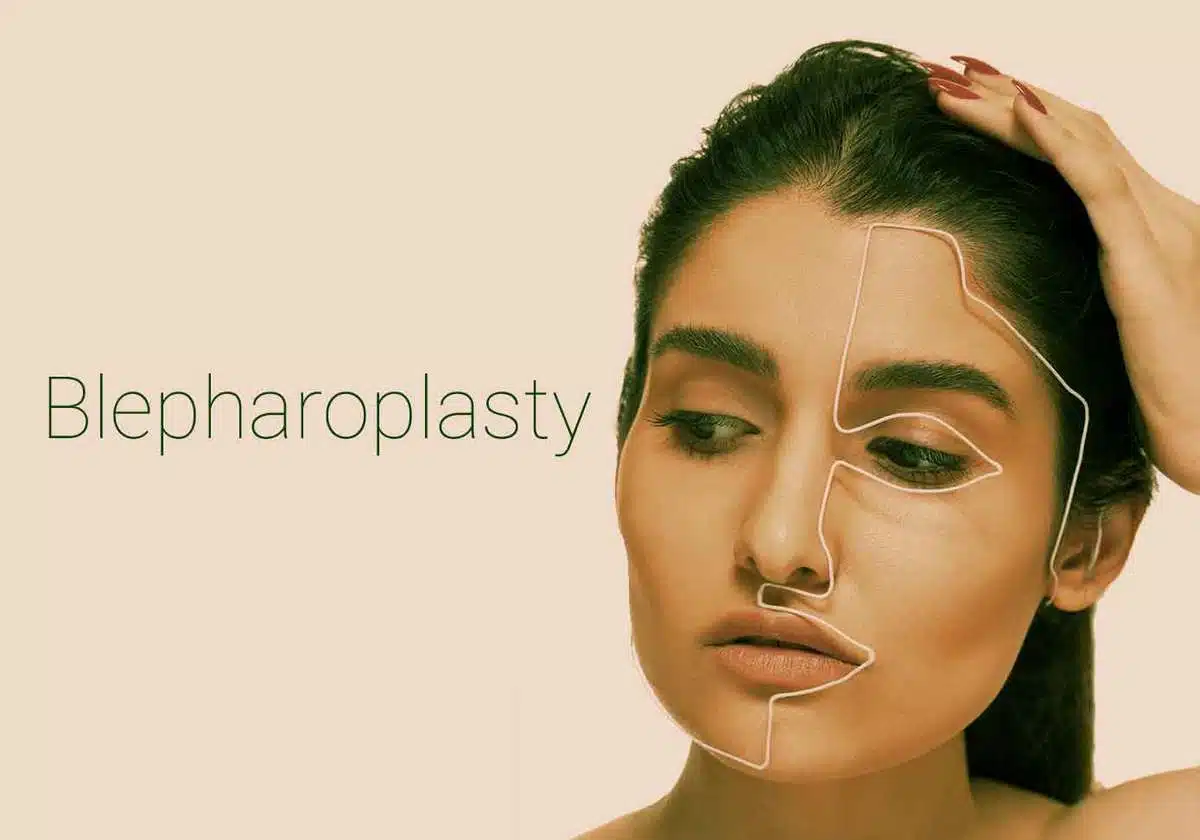 جراحة رأب الجفن أو جراحة الجفن
