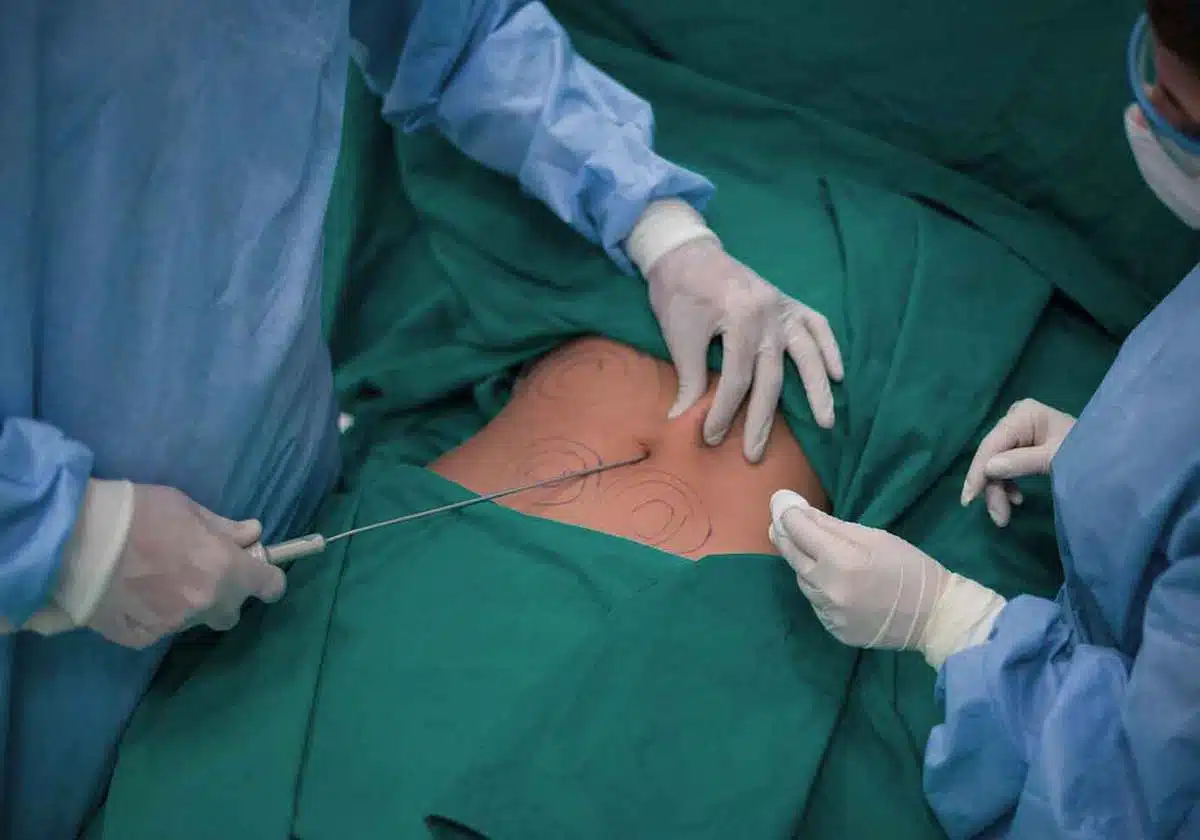 مخاطر شفط الدهون