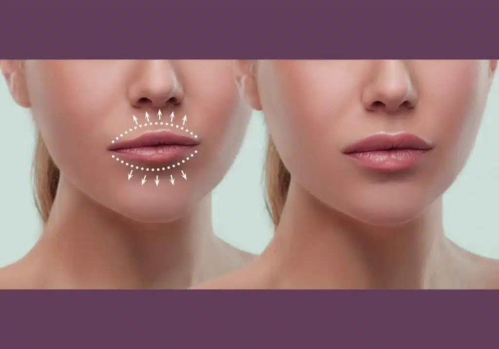 قبل از تزریق فیلر باید چه کارهایی انجام دهید؟