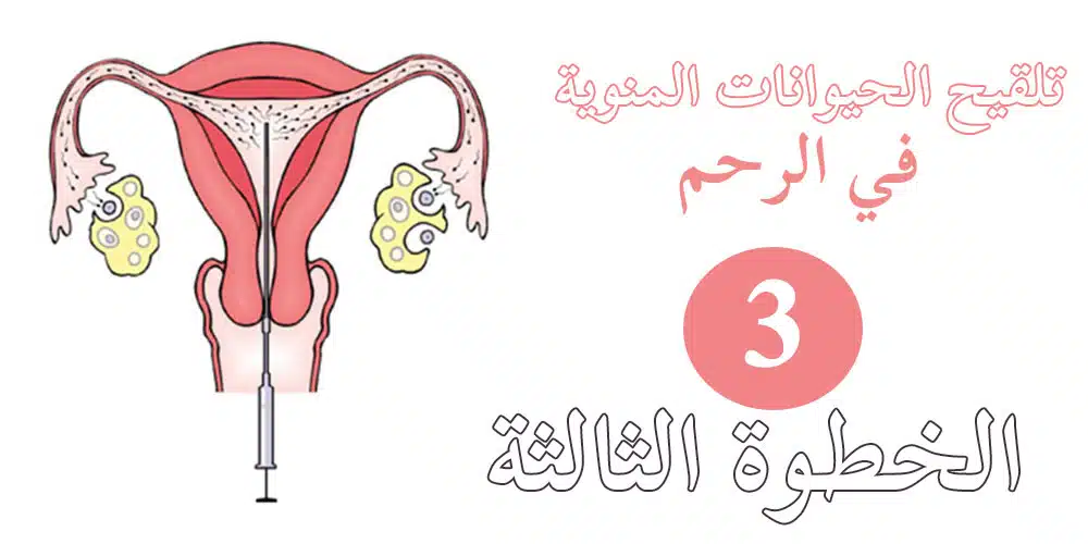 تلقيح الصناعي بالصور الخطوة الثالثة الإخصاب