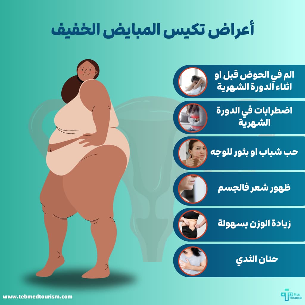 أعراض تكيس المبايض الخفيف