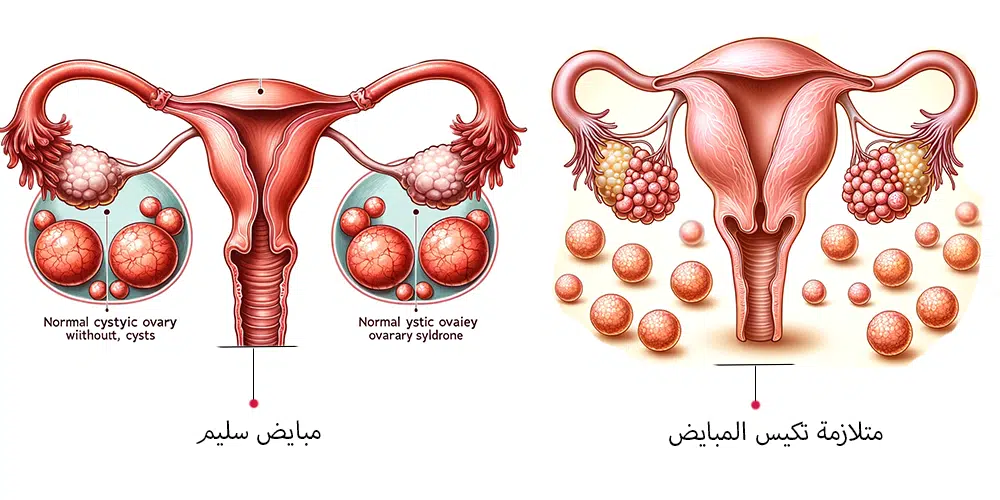 متلازمة تكيس المبايض يمكن أن تسبب العقم عند النساء.