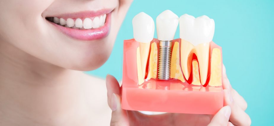 implant-candidate-min-925x425