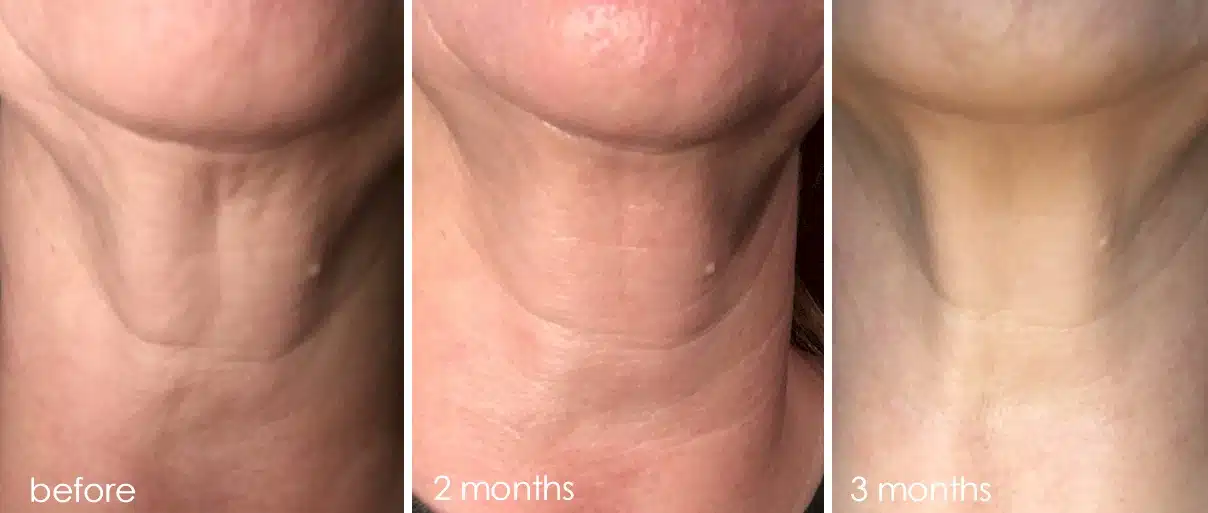 57-neck-after-3months
