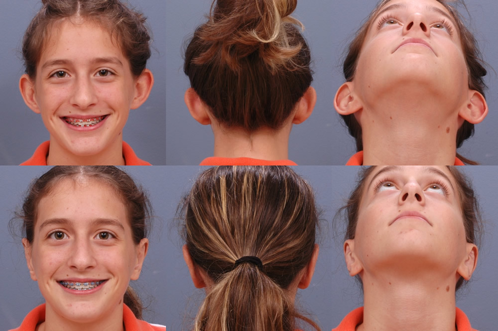 ear-surgery-otoplasty-13