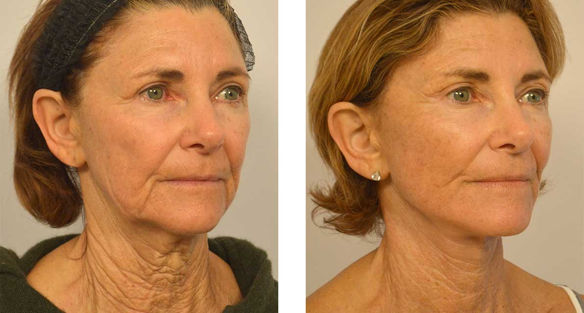 facelifts3-or